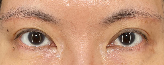 眉下リフトで睫毛の生え際を見せて、二重幅を広げた症例写真,After（1ヶ月後）,ba_jougankenlift014_a01.jpg