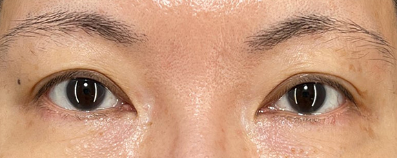 眉下リフトで睫毛の生え際を見せて、二重幅を広げた症例写真,Before,ba_jougankenlift014_b01.jpg