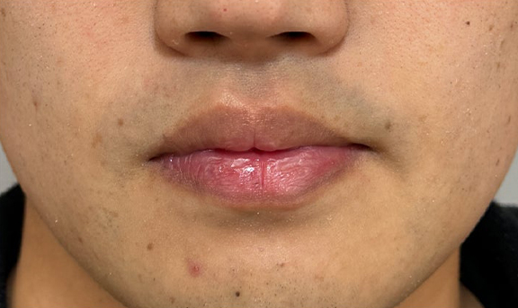 2ヶ月の時間差で口唇縮小術を行った症例写真,Before,ba_usuku028_b01.jpg