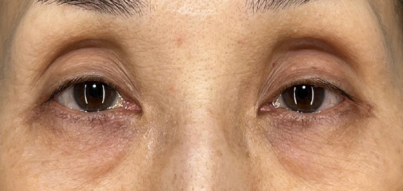 症例写真,眼瞼下垂手術＋表ハムラを行った症例写真,Before,ba_ganken051_b01.jpg