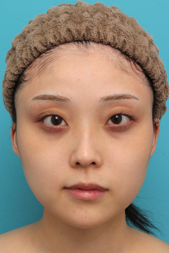 シリコンプロテーゼで顎をシャープに前方に出した20代女性の症例写真,After（4ヶ月後）,ba_ago028_a01.jpg