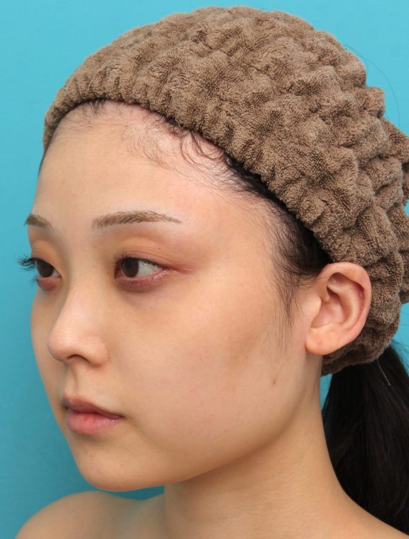 症例写真,シリコンプロテーゼで顎をシャープに前方に出した20代女性の症例写真,After(4ヶ月後),ba_ago028_b02.jpg