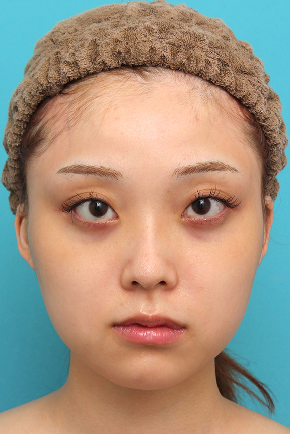 シリコンプロテーゼで顎をシャープに前方に出した20代女性の症例写真,Before,ba_ago028_b01.jpg