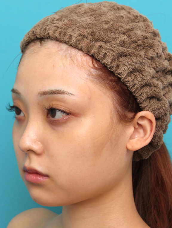 症例写真,シリコンプロテーゼで顎をシャープに前方に出した20代女性の症例写真,Before,ba_ago028_b02.jpg