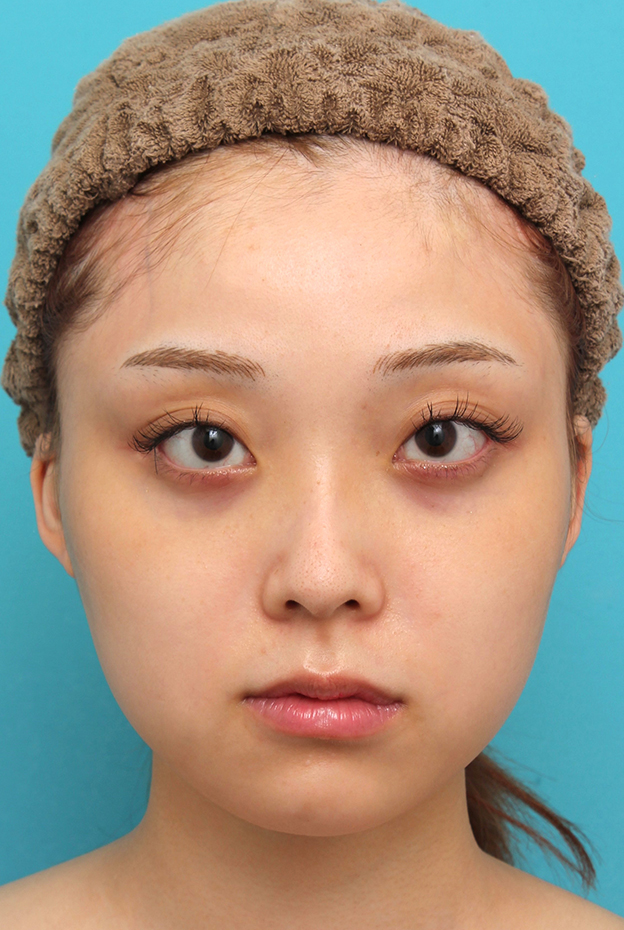 症例写真,シリコンプロテーゼで顎をシャープに前方に出した20代女性の症例写真,手術前,mainpic_ago028a.jpg