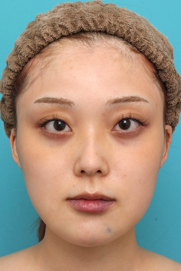 症例写真,シリコンプロテーゼで顎をシャープに前方に出した20代女性の症例写真,手術直後,mainpic_ago028b.jpg