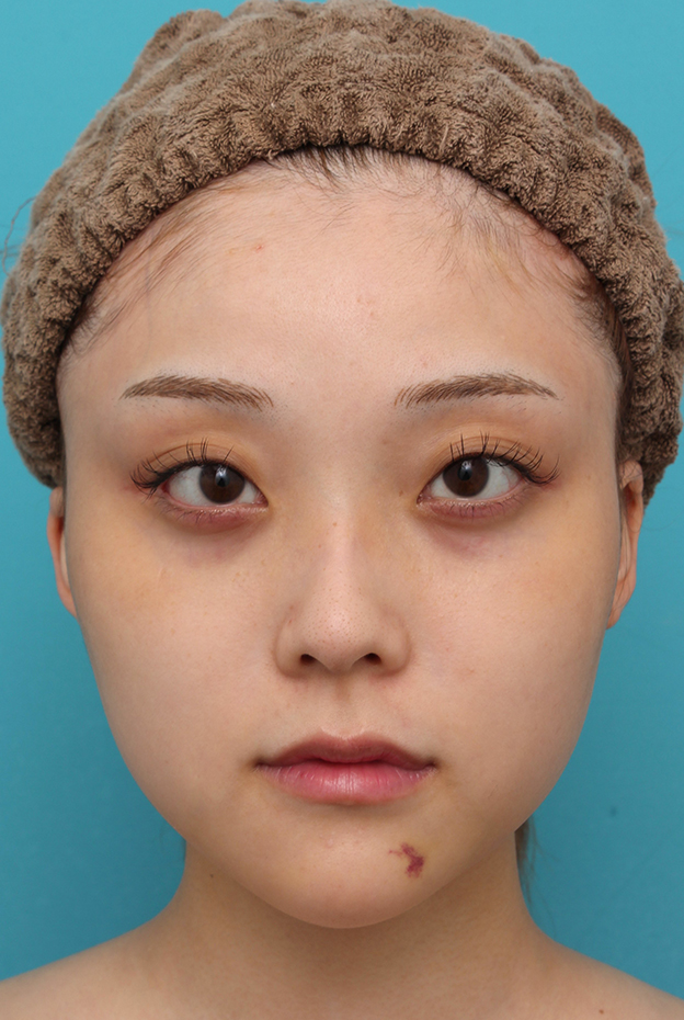 症例写真,シリコンプロテーゼで顎をシャープに前方に出した20代女性の症例写真,1週間後,mainpic_ago028c.jpg