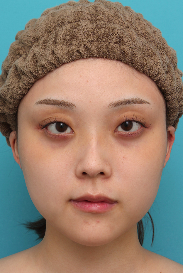 症例写真,シリコンプロテーゼで顎をシャープに前方に出した20代女性の症例写真,3週間後,mainpic_ago028d.jpg