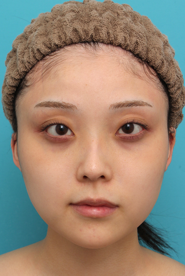 症例写真,シリコンプロテーゼで顎をシャープに前方に出した20代女性の症例写真,4ヶ月後,mainpic_ago028e.jpg