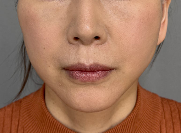 フルフェイスリフトでフェイスラインと首のたるみを改善した症例写真,After（2週間後）,ba_facelift009_a01.jpg