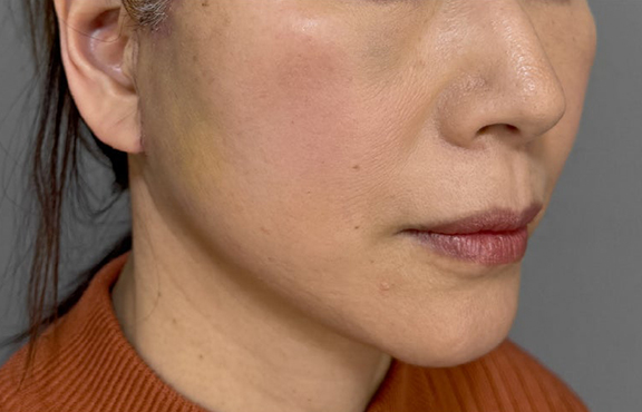 症例写真,フルフェイスリフトでフェイスラインと首のたるみを改善した症例写真,After（2週間後）,ba_facelift009_b02.jpg
