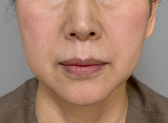 フルフェイスリフトでフェイスラインと首のたるみを改善した症例写真,Before,ba_facelift009_b01.jpg