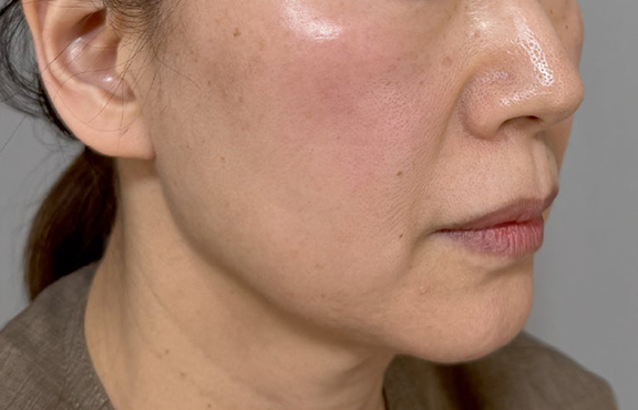 症例写真,フルフェイスリフトでフェイスラインと首のたるみを改善した症例写真,Before,ba_facelift009_b02.jpg
