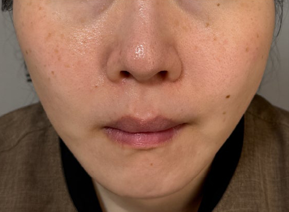 ミニフェイスリフトと脂肪吸引（あご下）を行った症例写真,After（6ヶ月後）,ba_minilift026_a01.jpg