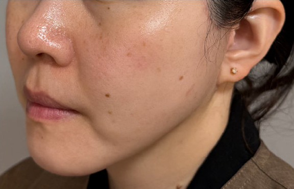 症例写真,ミニフェイスリフトと脂肪吸引（あご下）を行った症例写真,After（6ヶ月後）,ba_minilift026_b02.jpg