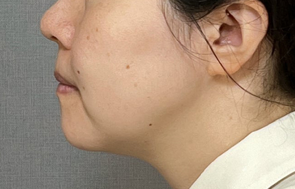 症例写真,ミニフェイスリフトと脂肪吸引（あご下）を行った症例写真,Before,ba_minilift026_b03.jpg
