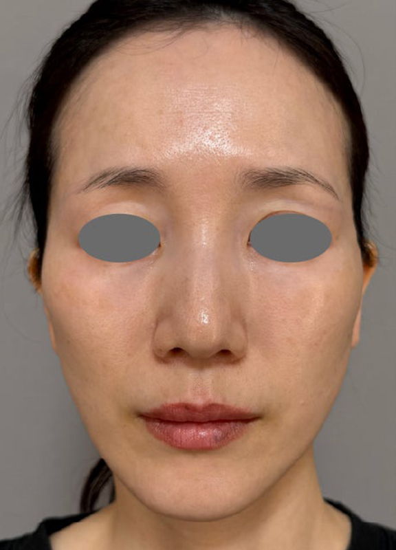 ミディアムフェイスリフトであご下と首ををすっきりさせた症例写真,After（1ヶ月後）,ba_mediumlift028_a01.jpg