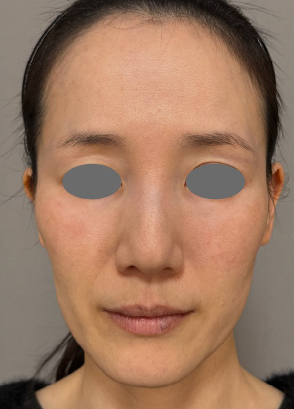 ミディアムフェイスリフトであご下と首ををすっきりさせた症例写真,Before,ba_mediumlift028_b01.jpg