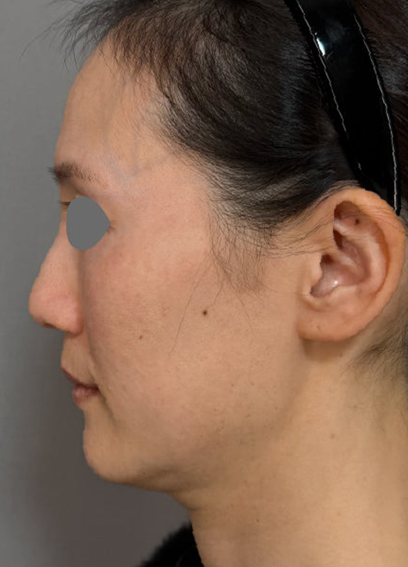 症例写真,ミディアムフェイスリフトであご下と首ををすっきりさせた症例写真,Before,ba_mediumlift028_b02.jpg