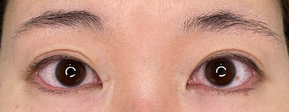 二重まぶた全切開法でまぶたの重み・厚みを同時に改善した症例写真,After（6ヶ月後）,ba_sekkai110_a01.jpg
