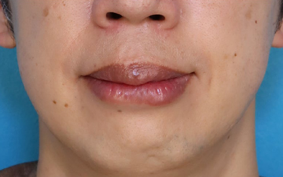 上下の口唇の厚みに口唇縮小術を行った40代男性の症例写真,After（1ヶ月後）,ba_usuku029_a01.jpg