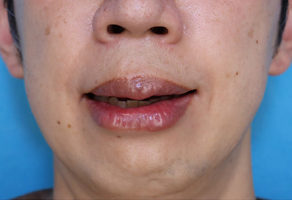 症例写真,上下の口唇の厚みに口唇縮小術を行った40代男性の症例写真,After（1ヶ月後）,ba_usuku029_b02.jpg