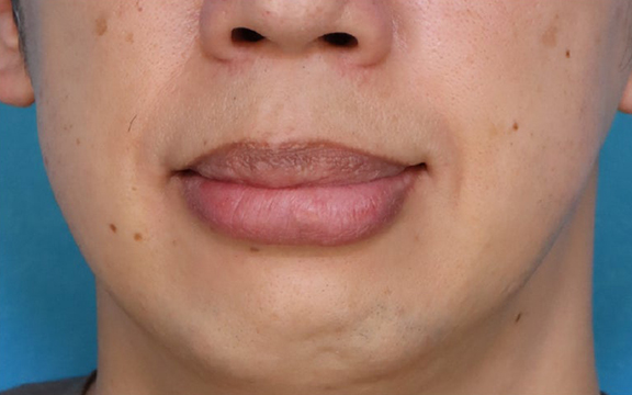 上下の口唇の厚みに口唇縮小術を行った40代男性の症例写真,Before,ba_usuku029_b01.jpg