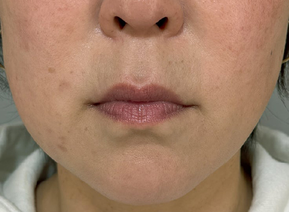 口角挙上術を行った症例写真,After（3ヶ月後）,ba_lipsup001_a01.jpg