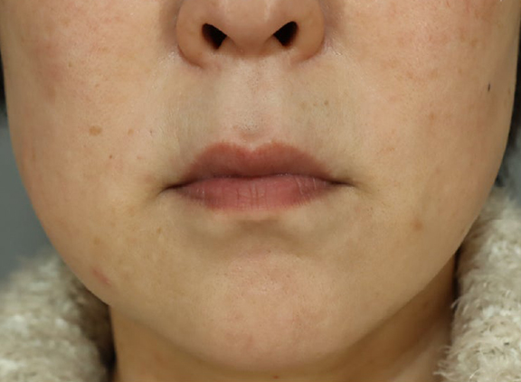 口角挙上術を行った症例写真,Before,ba_lipsup001_b01.jpg