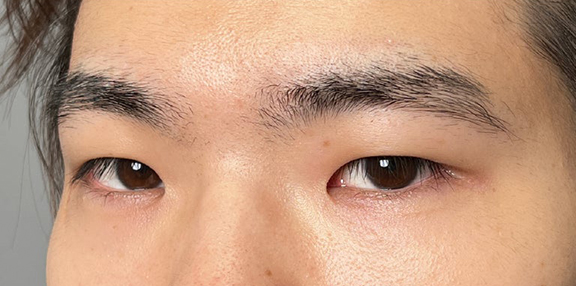 症例写真,二重全切開＋目頭切開で自然な二重を作った20代男性の症例写真,Before,ba_sekkai112_b02.jpg