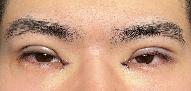症例写真,二重全切開＋目頭切開で自然な二重を作った20代男性の症例写真,施術直後,mainpic_sekkai112b.jpg