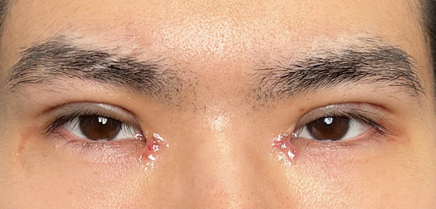 症例写真,二重全切開＋目頭切開で自然な二重を作った20代男性の症例写真,抜糸後（1週間後）,mainpic_sekkai112c.jpg