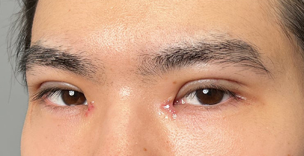 症例写真,二重全切開＋目頭切開で自然な二重を作った20代男性の症例写真,抜糸後（1週間後）,mainpic_sekkai112h.jpg
