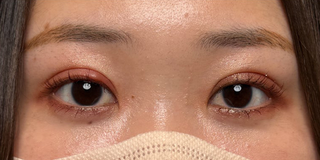 症例写真,埋没法で取れてしまった二重を、全切開法で希望の幅に整えた20代女性の症例写真,3ヶ月後,メイクあり,futaezensekkai1_6.jpg