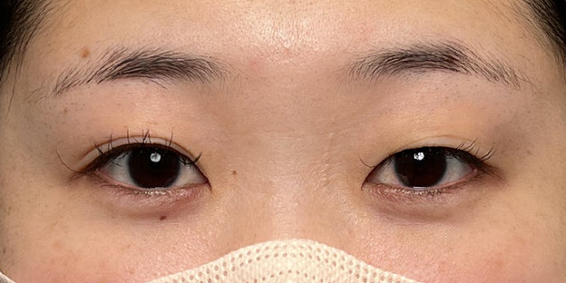 症例写真,埋没法で取れてしまった二重を、全切開法で希望の幅に整えた20代女性の症例写真,施術前,目を開けた状態,mainpic_sekkai113a.jpg