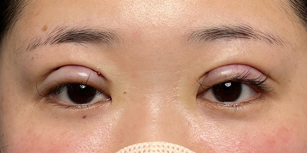 症例写真,埋没法で取れてしまった二重を、全切開法で希望の幅に整えた20代女性の症例写真,施術直後,目を開けた状態,mainpic_sekkai113c.jpg