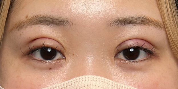 症例写真,埋没法で取れてしまった二重を、全切開法で希望の幅に整えた20代女性の症例写真,抜糸後（施術1週間後）,目を開けた状態,mainpic_sekkai113e.jpg