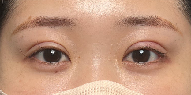 症例写真,埋没法で取れてしまった二重を、全切開法で希望の幅に整えた20代女性の症例写真,1ヶ月後,目を開けた状態,mainpic_sekkai113g.jpg