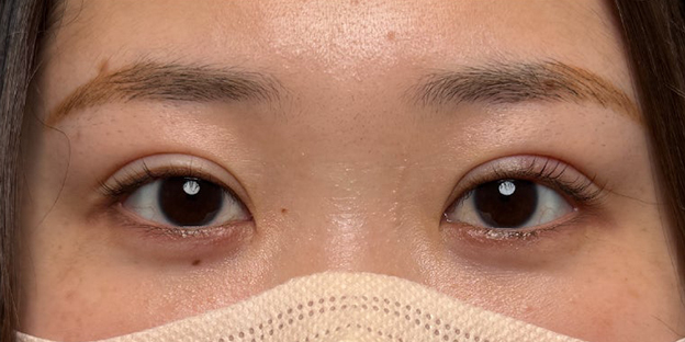 症例写真,埋没法で取れてしまった二重を、全切開法で希望の幅に整えた20代女性の症例写真,3ヶ月後,メイクなし・目を開けた状態,mainpic_sekkai113i.jpg