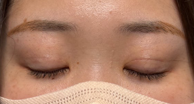 症例写真,埋没法で取れてしまった二重を、全切開法で希望の幅に整えた20代女性の症例写真,3ヶ月後,目を閉じた状態,mainpic_sekkai113j.jpg