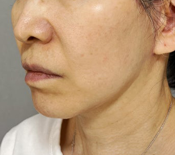 脂肪吸引（頬、あご下）,ミニフェイスリフトとあご下の脂肪吸引を行った症例写真,After（3ヶ月後）,ba_minilift028_b02.jpg
