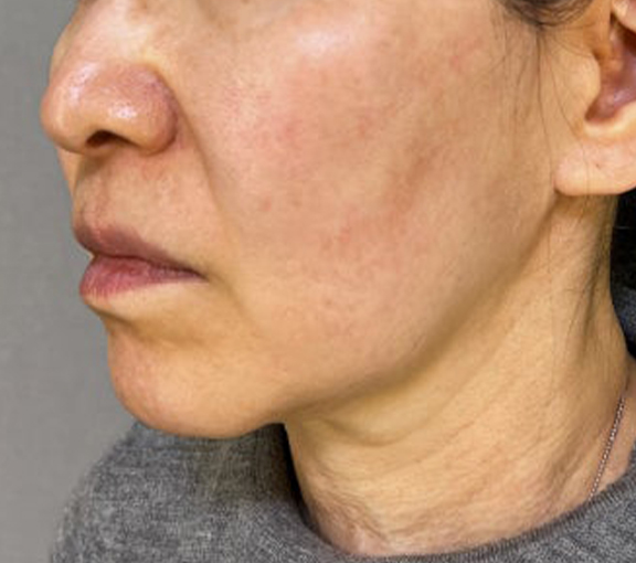 脂肪吸引（頬、あご下）,ミニフェイスリフトとあご下の脂肪吸引を行った症例写真,Before,ba_minilift028_b02.jpg
