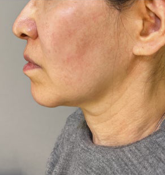脂肪吸引（頬、あご下）,ミニフェイスリフトとあご下の脂肪吸引を行った症例写真,Before,ba_minilift028_b03.jpg