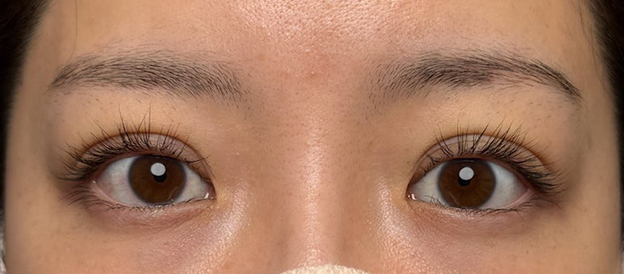 症例写真,連続埋没法で二重の左右差を整え幅を広げた症例写真,施術直後,mainpic_maibotsu3005b.jpg