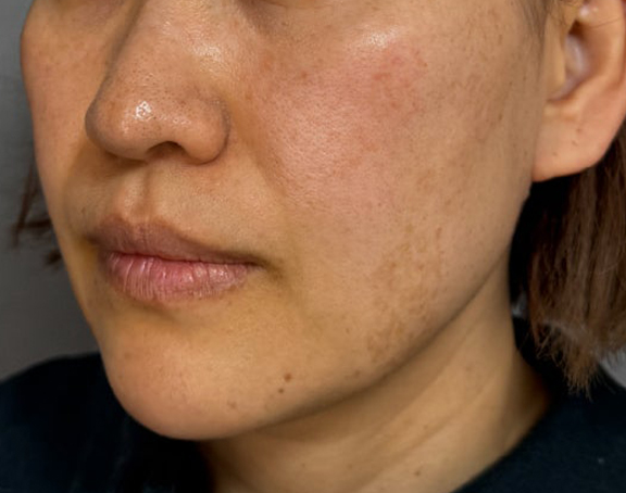 症例写真,イタリアンリフト、あご注射（ヒアルロン酸）、シワ取りヒアルロン酸注射を行った症例写真,After（3ヶ月後）,ba_italian040_b02.jpg