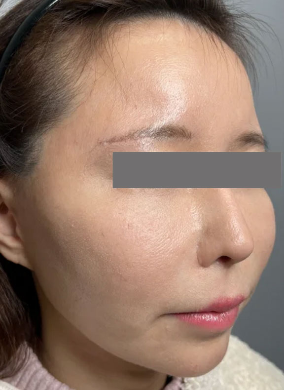 頬をふっくら・脂肪注入,頬に脂肪注入を行ってコケた印象を改善した症例写真,After（3ヶ月後）,ba_faceshibo006_b02.jpg