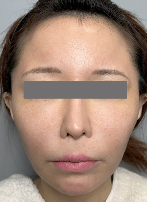 頬に脂肪注入を行ってコケた印象を改善した症例写真,Before,ba_faceshibo006_b01.jpg