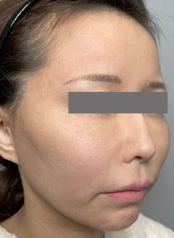 頬をふっくら・脂肪注入,頬に脂肪注入を行ってコケた印象を改善した症例写真,Before,ba_faceshibo006_b02.jpg