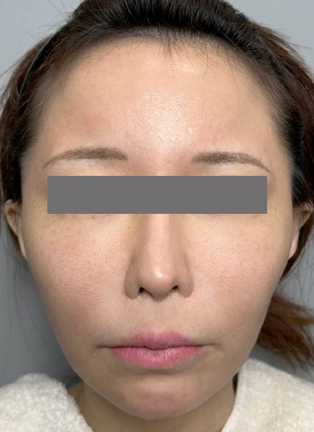 頬をふっくら・脂肪注入,頬に脂肪注入を行ってコケた印象を改善した症例写真,施術前,mainpic_faceshibo006a.jpg