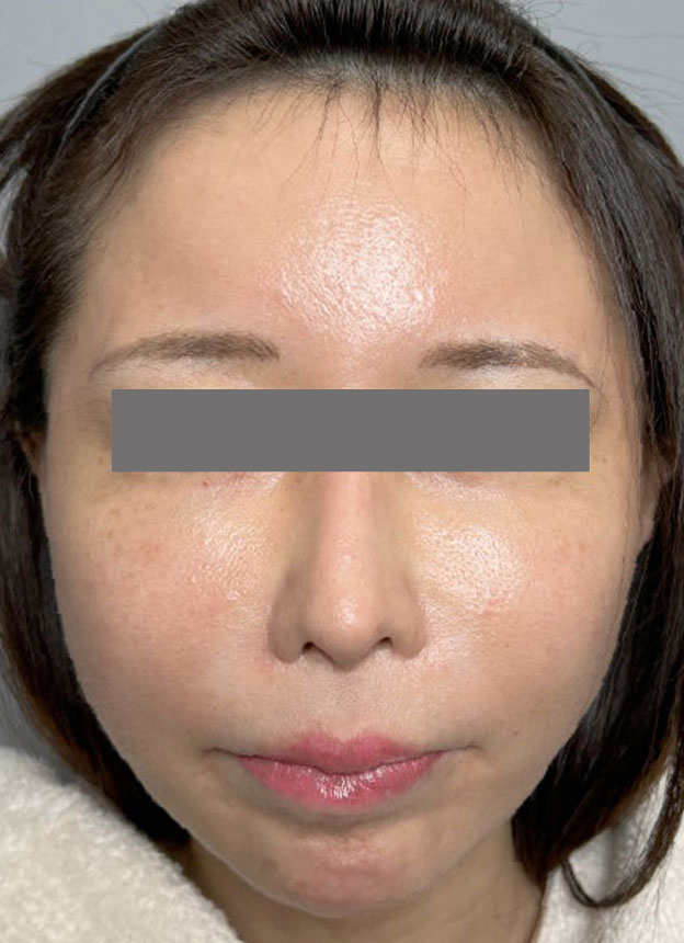 頬をふっくら・脂肪注入,頬に脂肪注入を行ってコケた印象を改善した症例写真,1週間後,mainpic_faceshibo006b.jpg